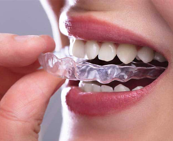 Bite: un apparecchio per molti usi…  Studio Dentistico Dr Franco Milaneschi