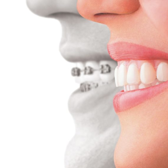 Studio Dentistico Dr Franco Milaneschi | Apparecchio invisibile